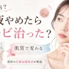 乳液やめたらニキビ治った